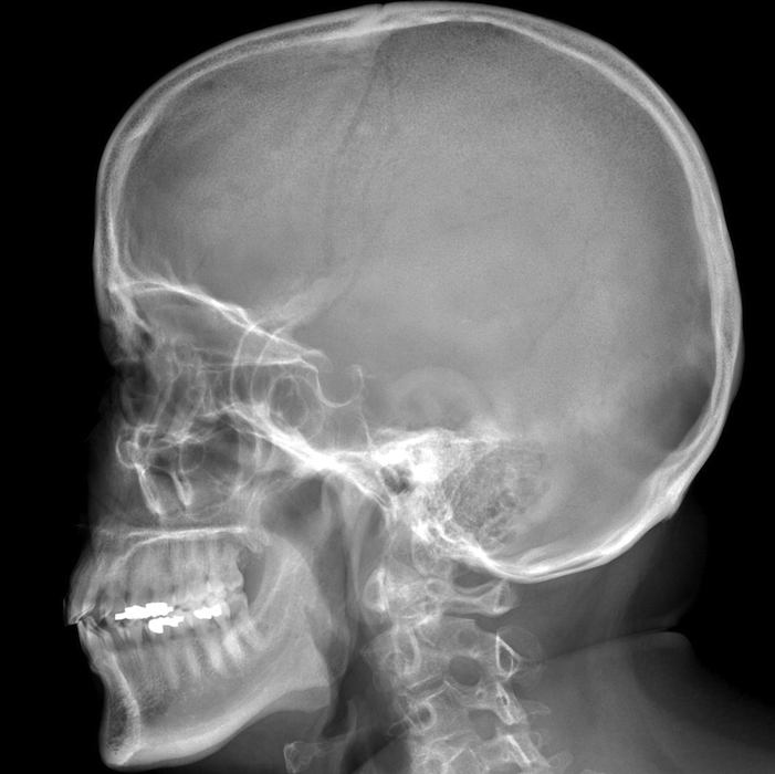 Figure 2 for case Paget disease ( RID3815 )